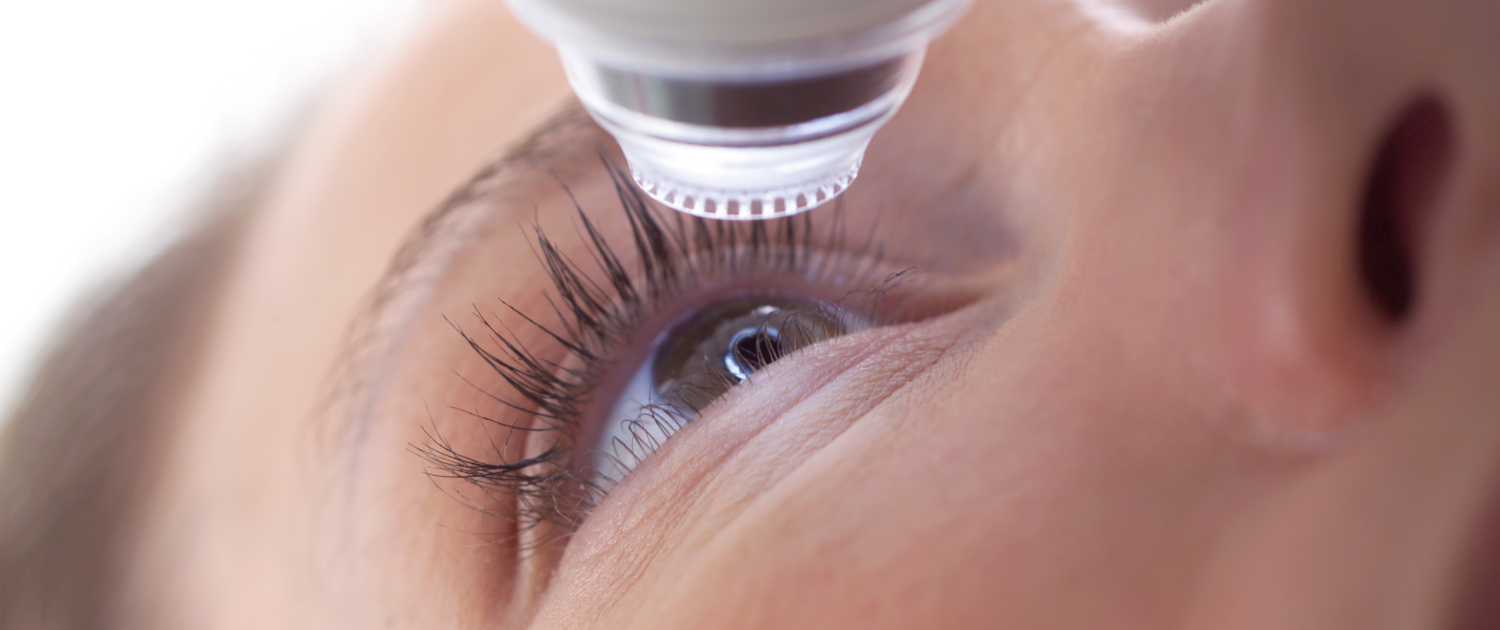 Lasik